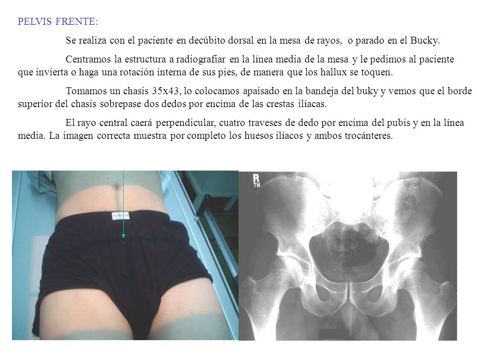 PELVIS FRENTE: Se realiza con el paciente en decúbito dorsal en la mesa de rayos, o parado en el Bucky.
