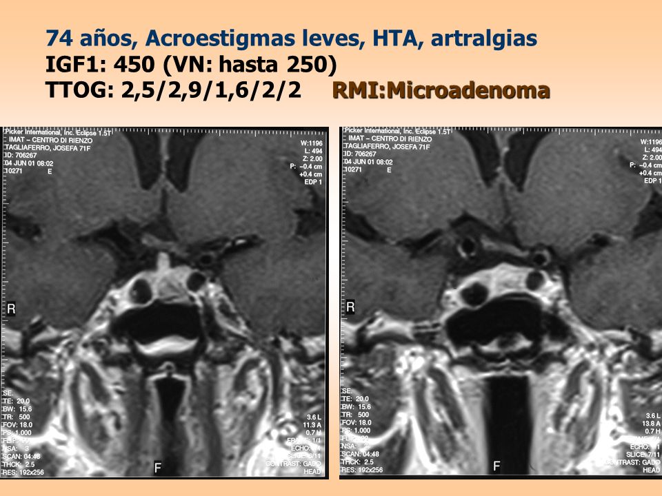 74 años, Acroestigmas leves, HTA, artralgias IGF1: 450 (VN: hasta 250) TTOG: 2,5/2,9/1,6/2/2 RMI:Microadenoma