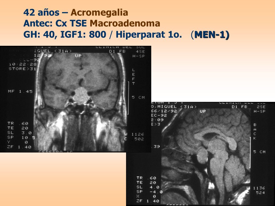 42 años – Acromegalia Antec: Cx TSE Macroadenoma GH: 40, IGF1: 800 / Hiperparat 1o. (MEN-1)