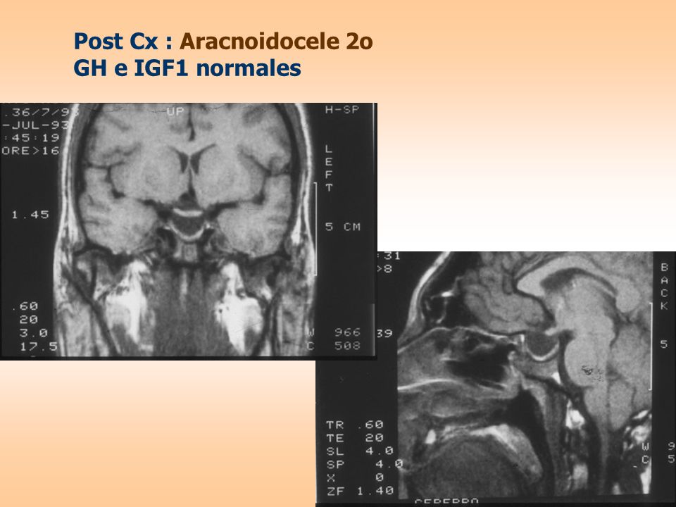 Post Cx : Aracnoidocele 2o GH e IGF1 normales