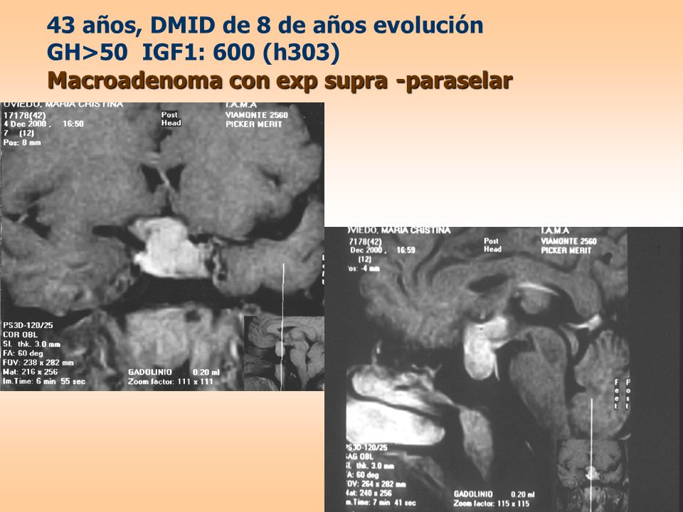 43 años, DMID de 8 de años evolución GH>50 IGF1: 600 (h303) Macroadenoma con exp supra -paraselar