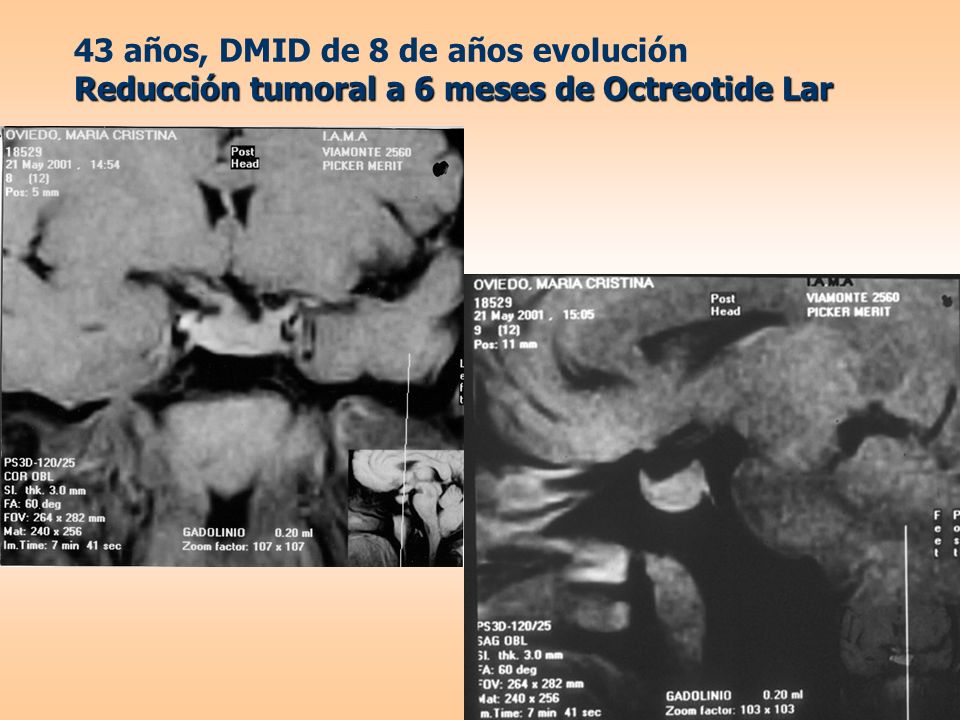 43 años, DMID de 8 de años evolución Reducción tumoral a 6 meses de Octreotide Lar