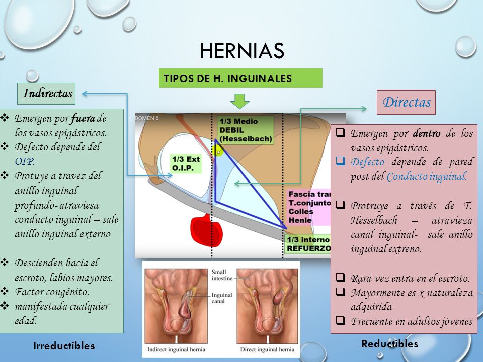 HERNIAS Directas Indirectas TIPOS DE H. INGUINALES