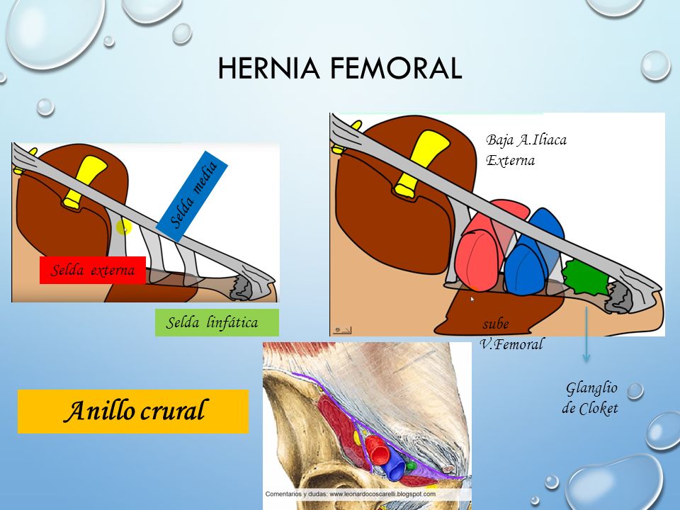 Hernia femoral Anillo crural Baja A.Iliaca Externa Selda media