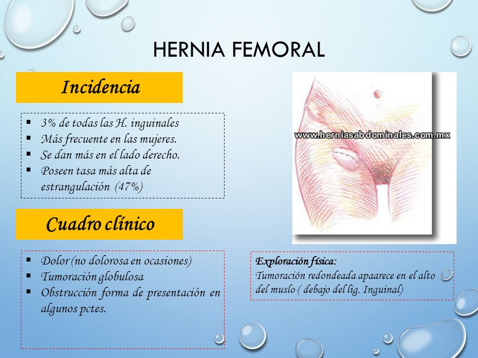 Hernia femoral Incidencia Cuadro clínico 3% de todas las H. inguinales