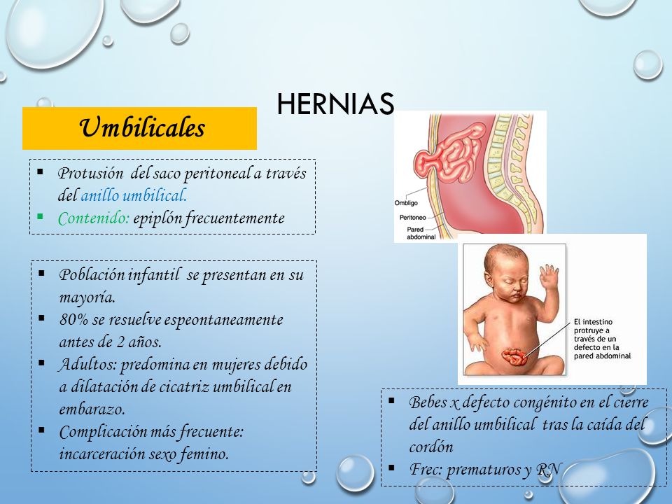 Hernias Umbilicales. Protusión del saco peritoneal a través del anillo umbilical. Contenido: epiplón frecuentemente.