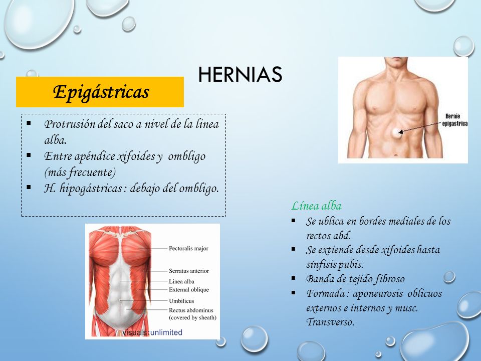 Hernias Epigástricas Protrusión del saco a nivel de la linea alba.