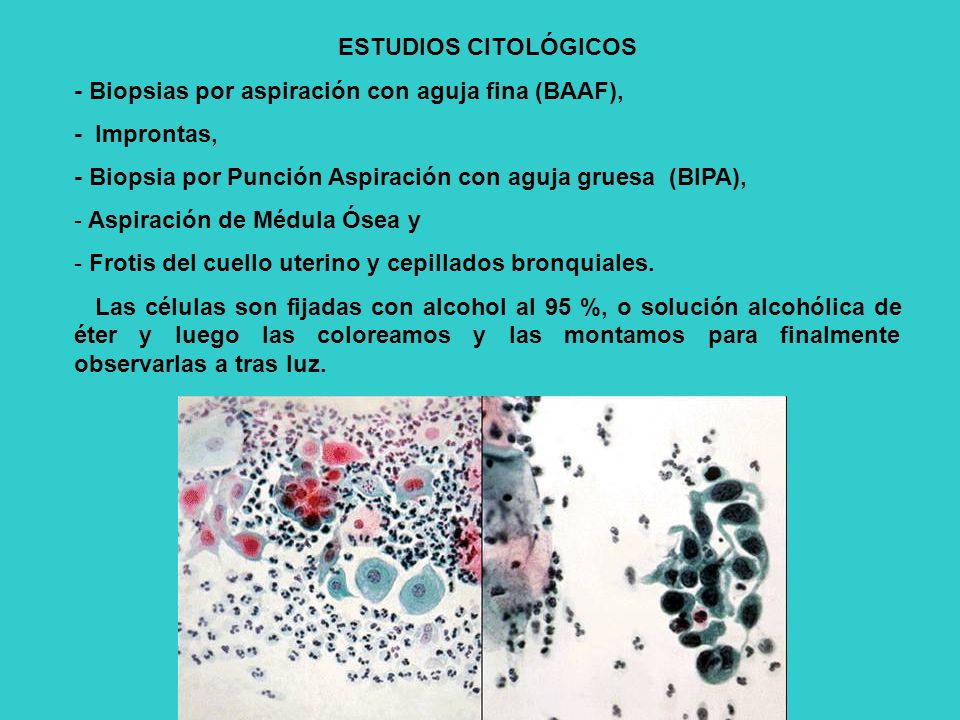 ESTUDIOS CITOLÓGICOS - Biopsias por aspiración con aguja fina (BAAF), - Improntas, - Biopsia por Punción Aspiración con aguja gruesa (BIPA),