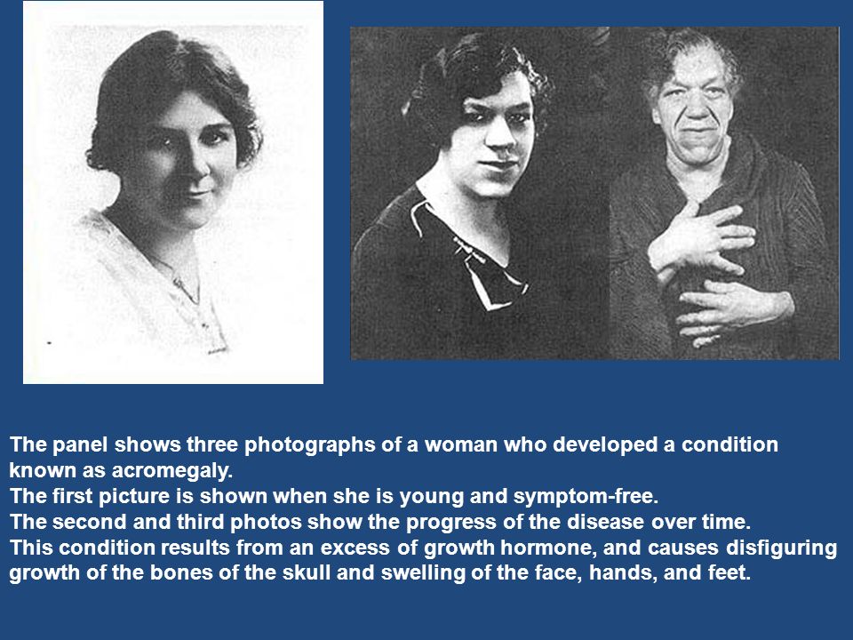 The panel shows three photographs of a woman who developed a condition known as acromegaly.