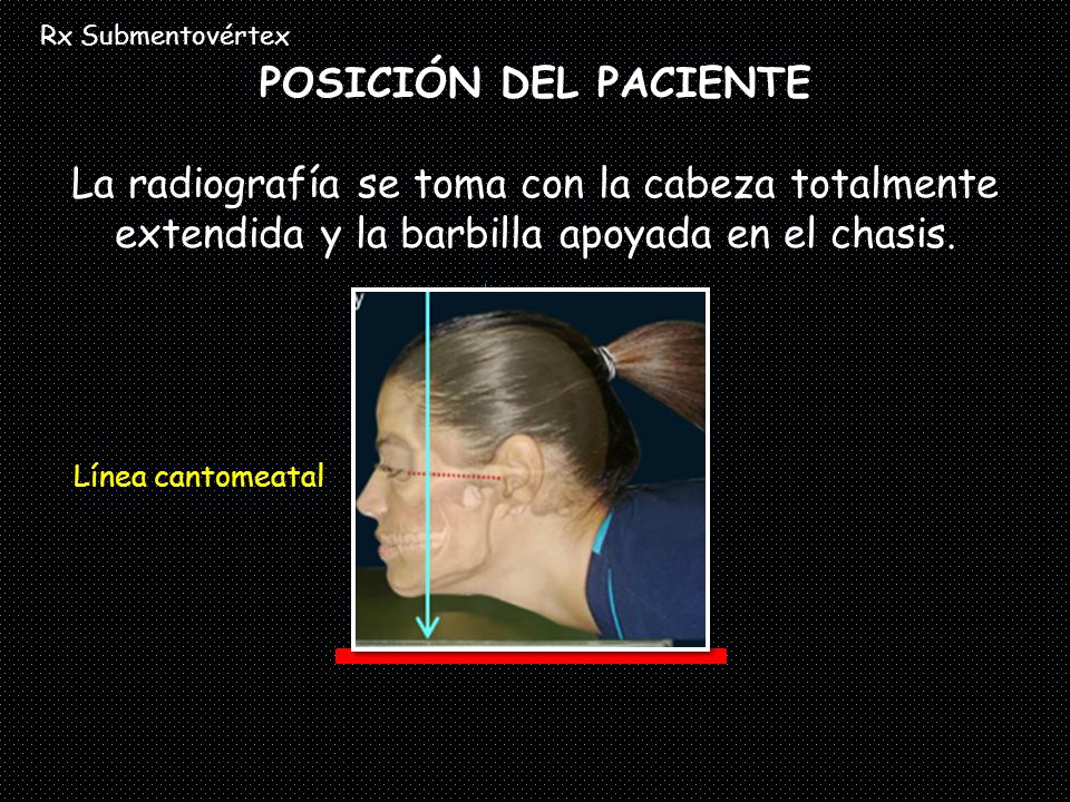 Rx Submentovértex POSICIÓN DEL PACIENTE La radiografía se toma con la cabeza totalmente extendida y la barbilla apoyada en el chasis.