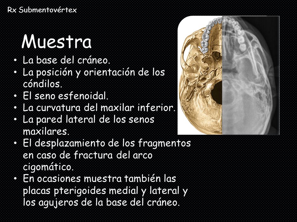 Muestra La base del cráneo. La posición y orientación de los cóndilos.