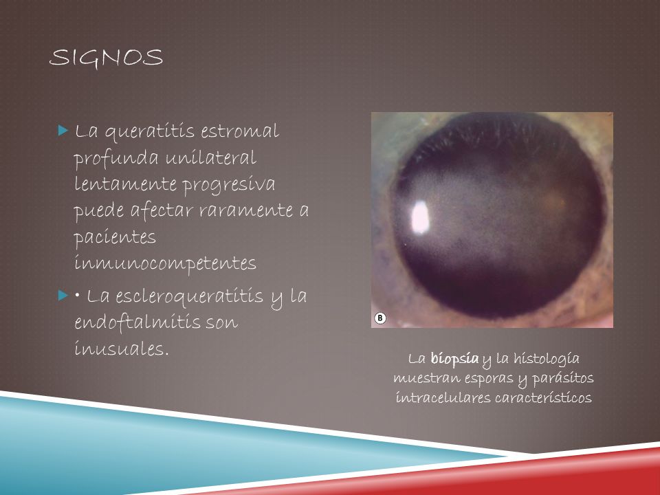SIGNOS La queratitis estromal profunda unilateral lentamente progresiva puede afectar raramente a pacientes inmunocompetentes.