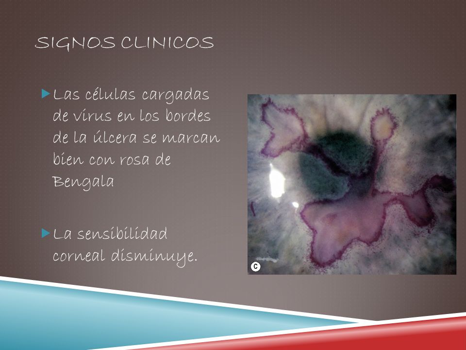SIGNOS CLINICOS Las células cargadas de virus en los bordes de la úlcera se marcan bien con rosa de Bengala.