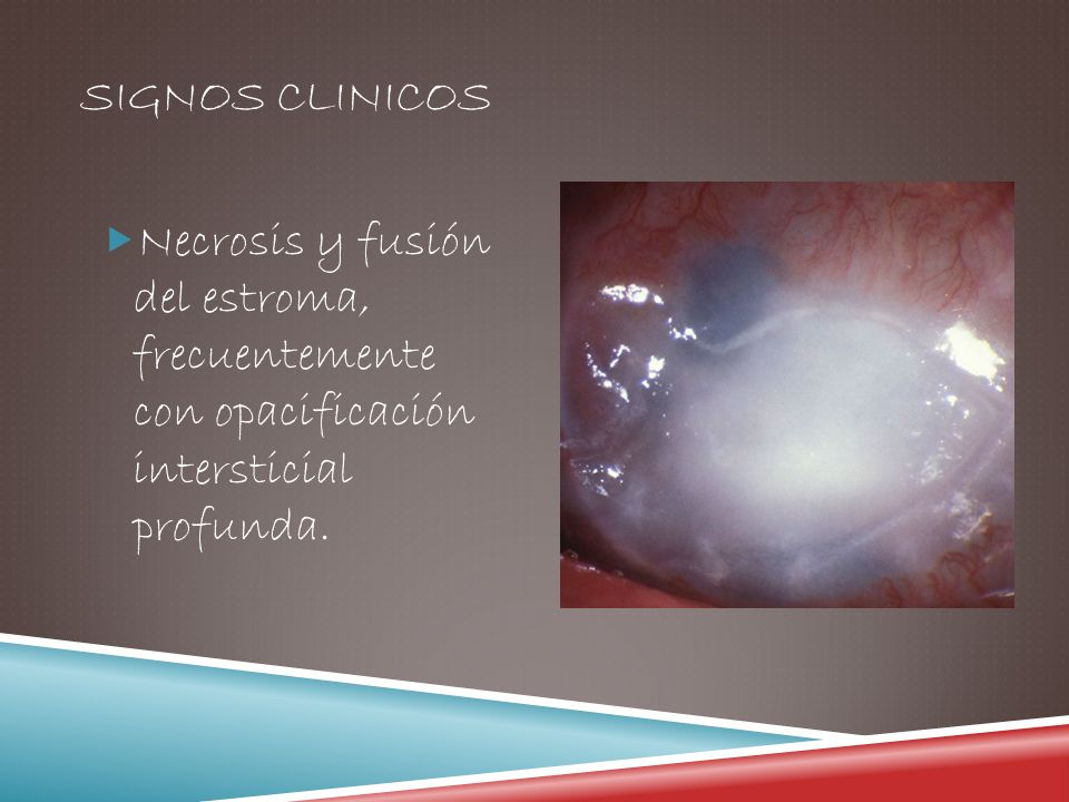 Signos clinicos Necrosis y fusión del estroma, frecuentemente con opacificación intersticial profunda.