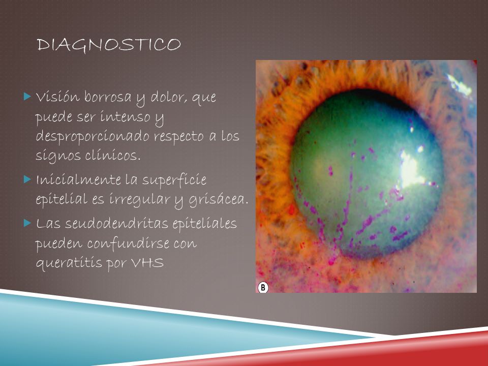 diagnostico Visión borrosa y dolor, que puede ser intenso y desproporcionado respecto a los signos clínicos.