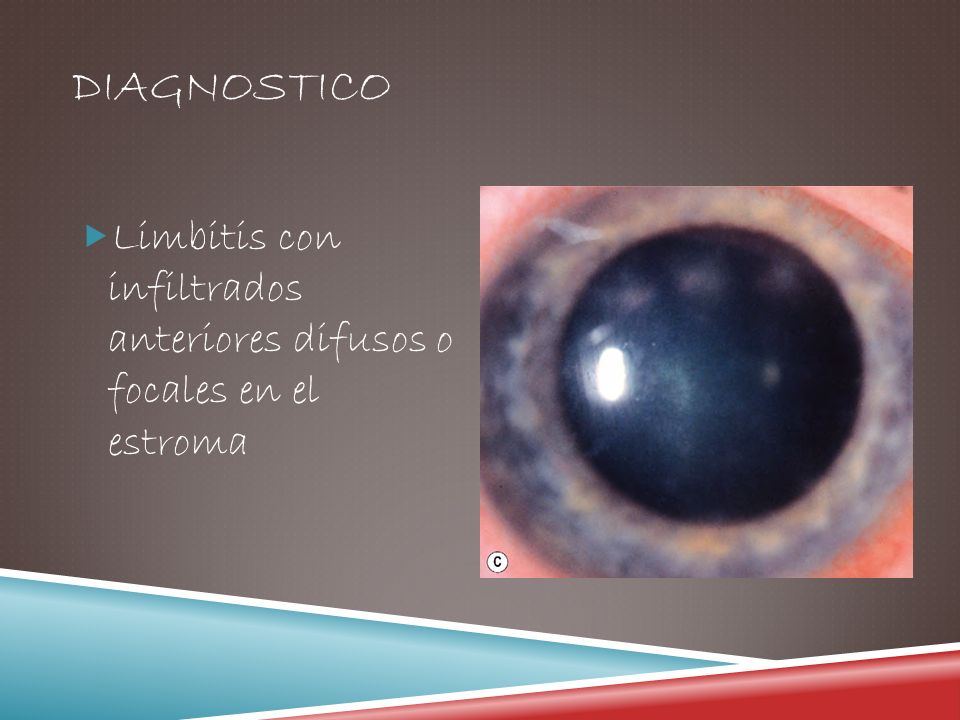 DIAGNOSTICO Limbitis con infiltrados anteriores difusos o focales en el estroma