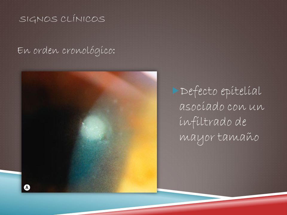 Defecto epitelial asociado con un infiltrado de mayor tamaño