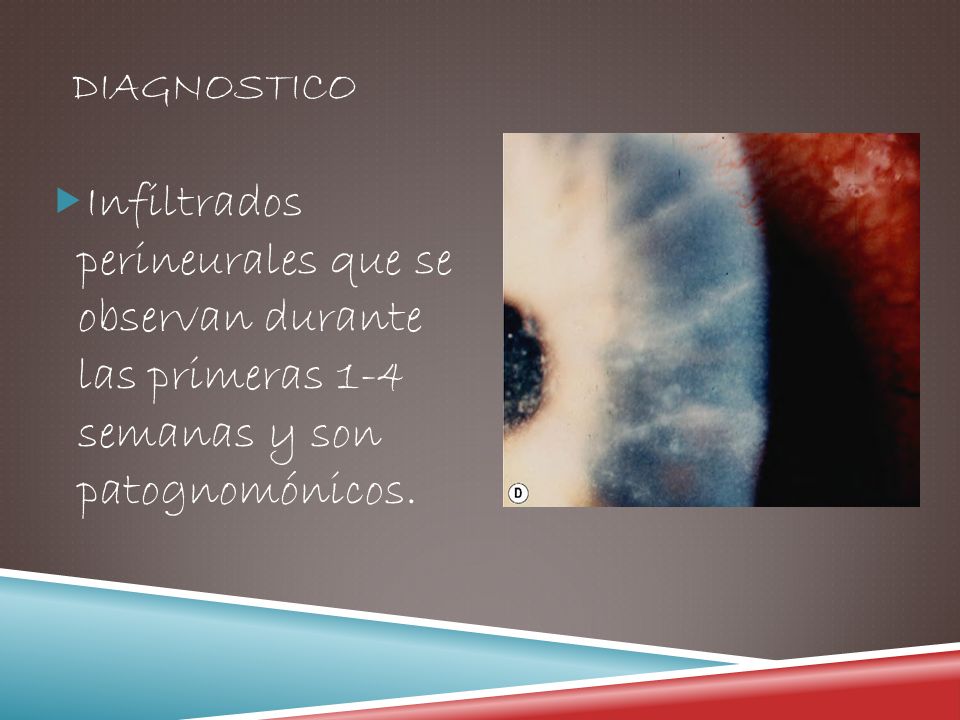 diagnostico Infiltrados perineurales que se observan durante las primeras 1-4 semanas y son patognomónicos.