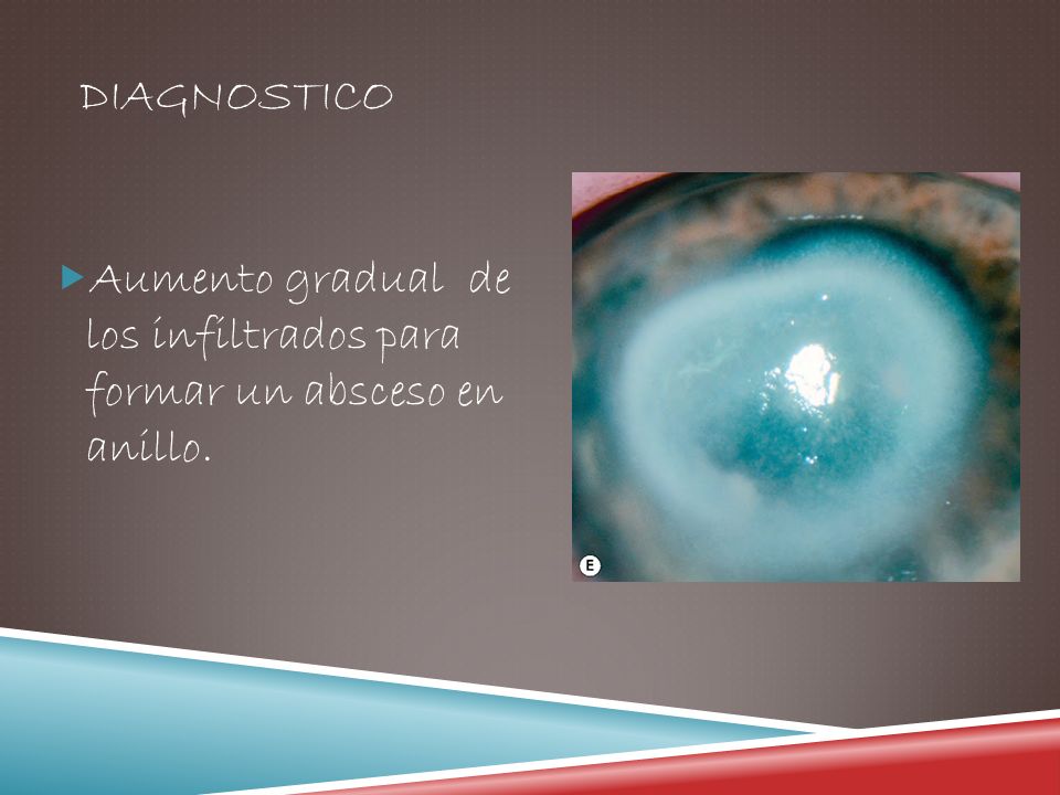 DIAGNOSTICO Aumento gradual de los infiltrados para formar un absceso en anillo.