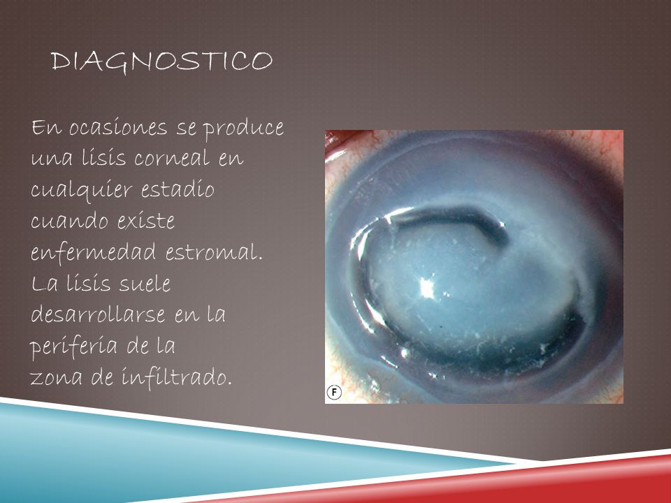 DIAGNOSTICO En ocasiones se produce una lisis corneal en cualquier estadio cuando existe enfermedad estromal.