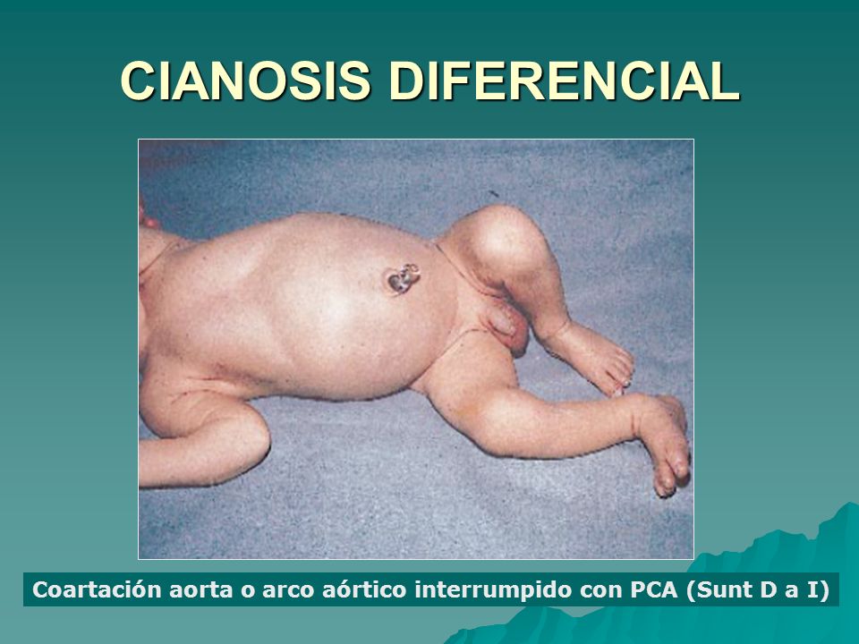 Coartación aorta o arco aórtico interrumpido con PCA (Sunt D a I)