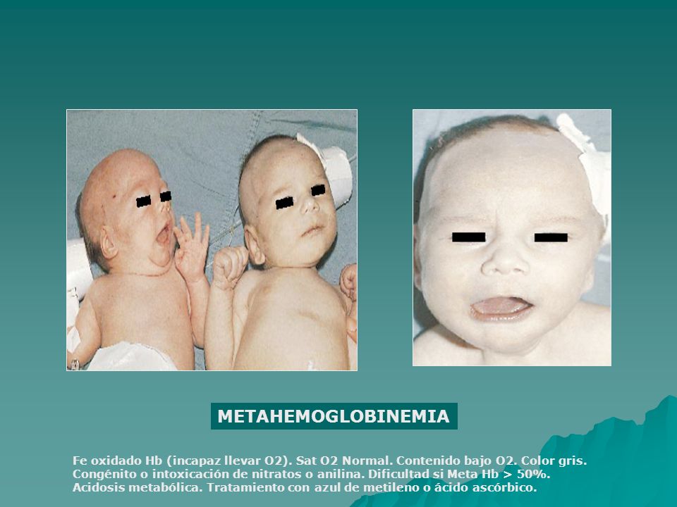 METAHEMOGLOBINEMIA Fe oxidado Hb (incapaz llevar O2). Sat O2 Normal. Contenido bajo O2. Color gris.