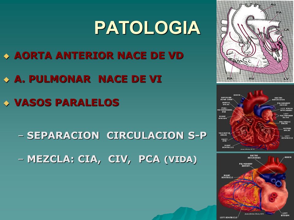 PATOLOGIA AORTA ANTERIOR NACE DE VD A. PULMONAR NACE DE VI