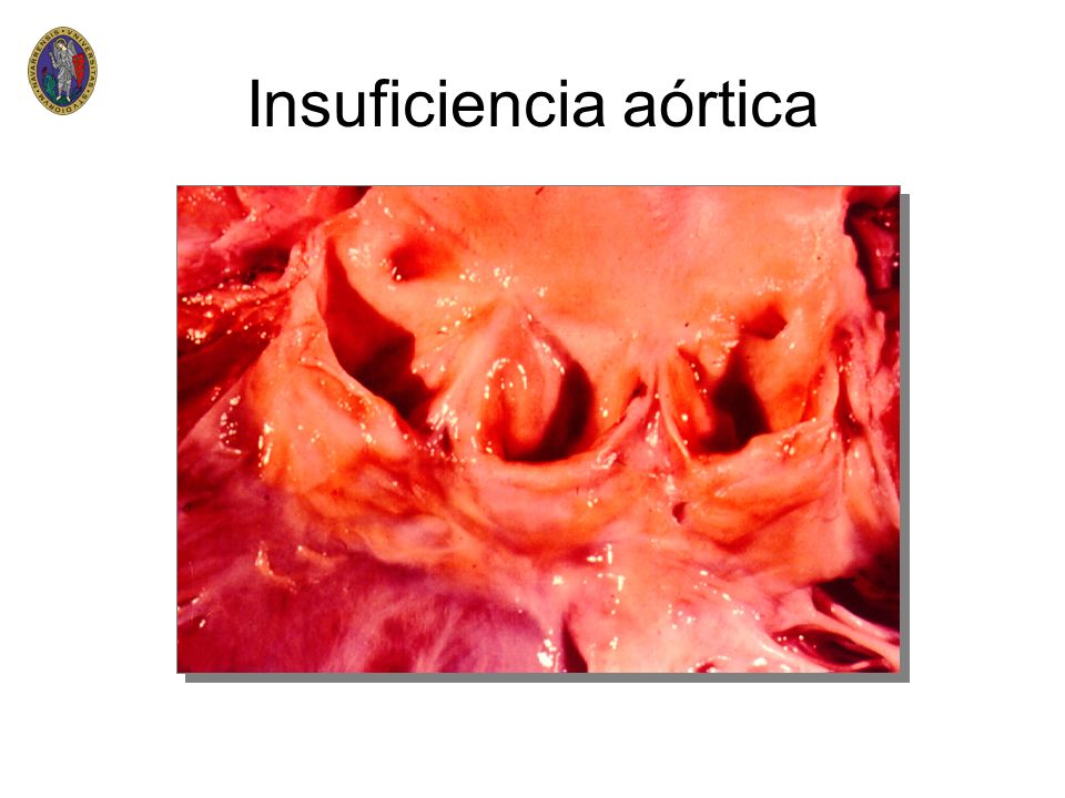Insuficiencia aórtica