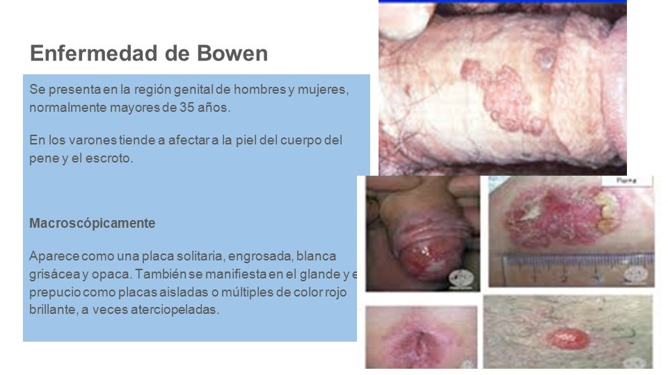 Enfermedad de Bowen Se presenta en la región genital de hombres y mujeres, normalmente mayores de 35 años.