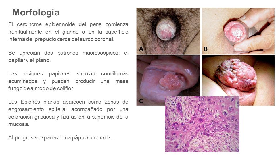 Morfología El carcinoma epidermoide del pene comienza habitualmente en el glande o en la superficie interna del prepucio cerca del surco coronal.
