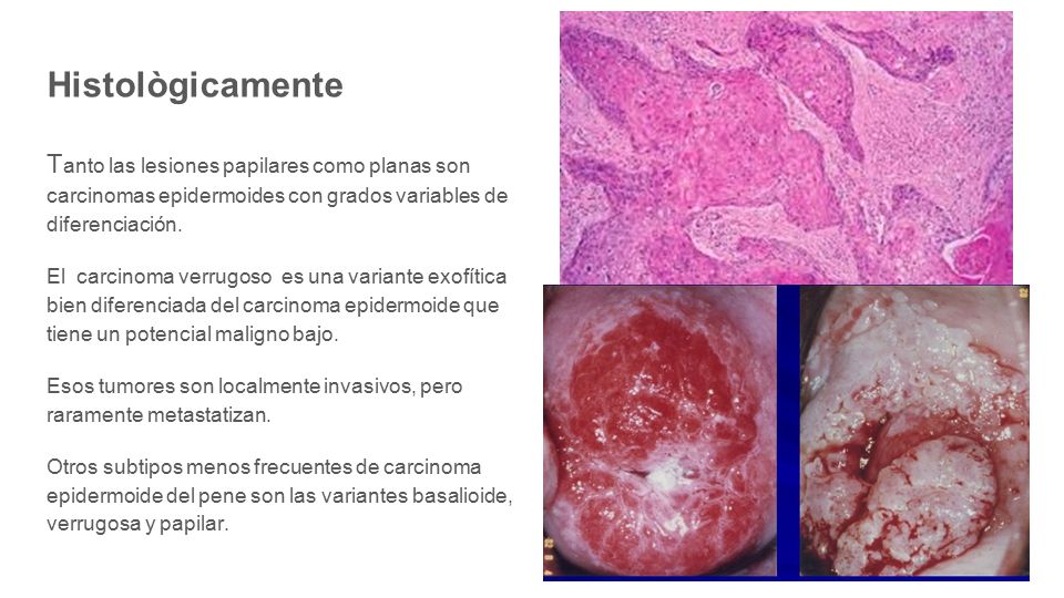 Histològicamente Tanto las lesiones papilares como planas son carcinomas epidermoides con grados variables de diferenciación.