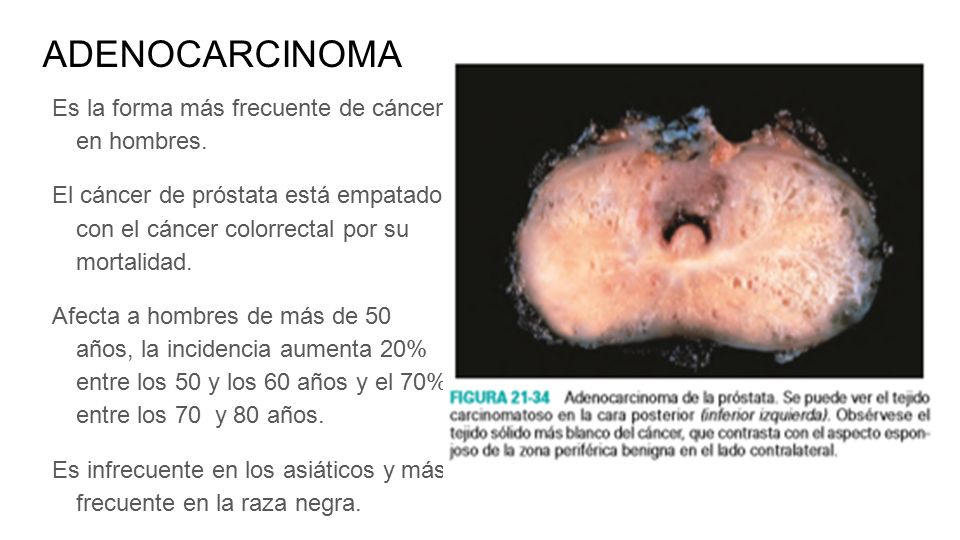 ADENOCARCINOMA Es la forma más frecuente de cáncer en hombres.