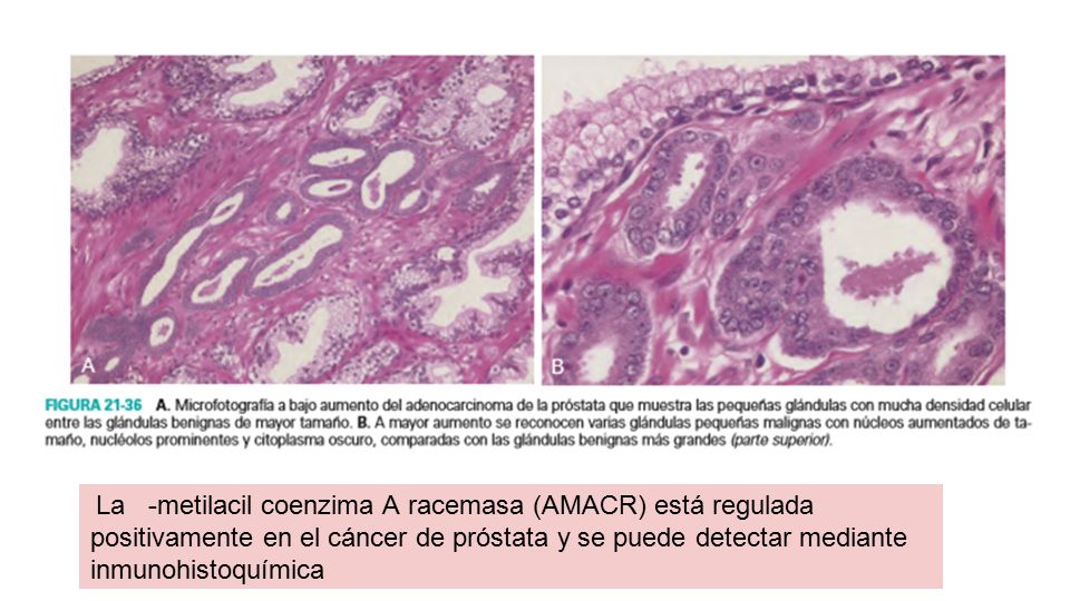 La -metilacil coenzima A racemasa (AMACR) está regulada positivamente en el cáncer de próstata y se puede detectar mediante inmunohistoquímica