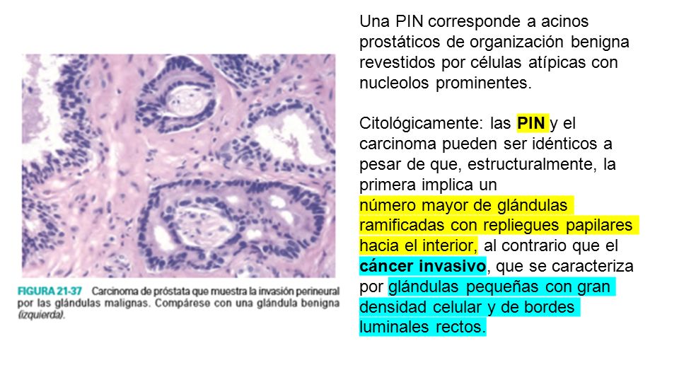 Una PIN corresponde a acinos prostáticos de organización benigna revestidos por células atípicas con nucleolos prominentes.