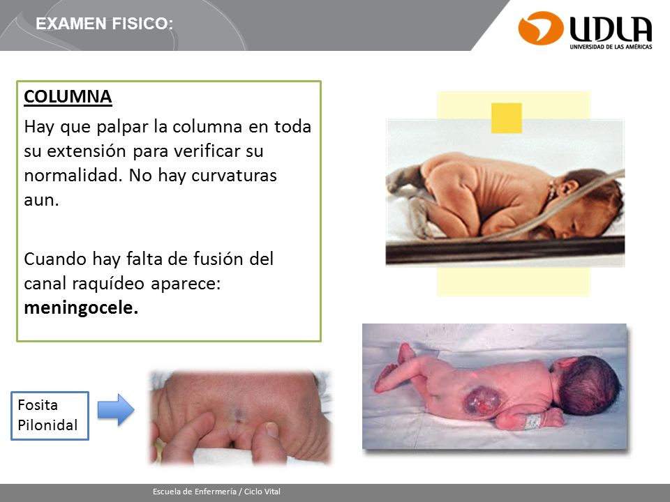 Cuando hay falta de fusión del canal raquídeo aparece: meningocele.