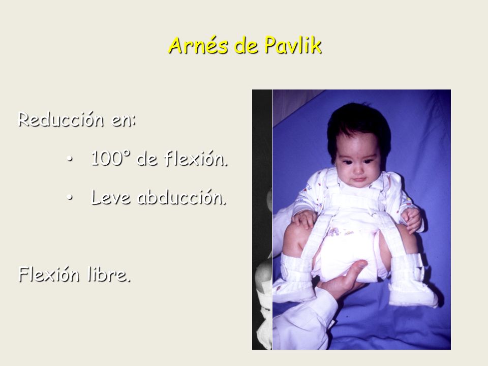 Arnés de Pavlik Reducción en: 100° de flexión. Leve abducción.