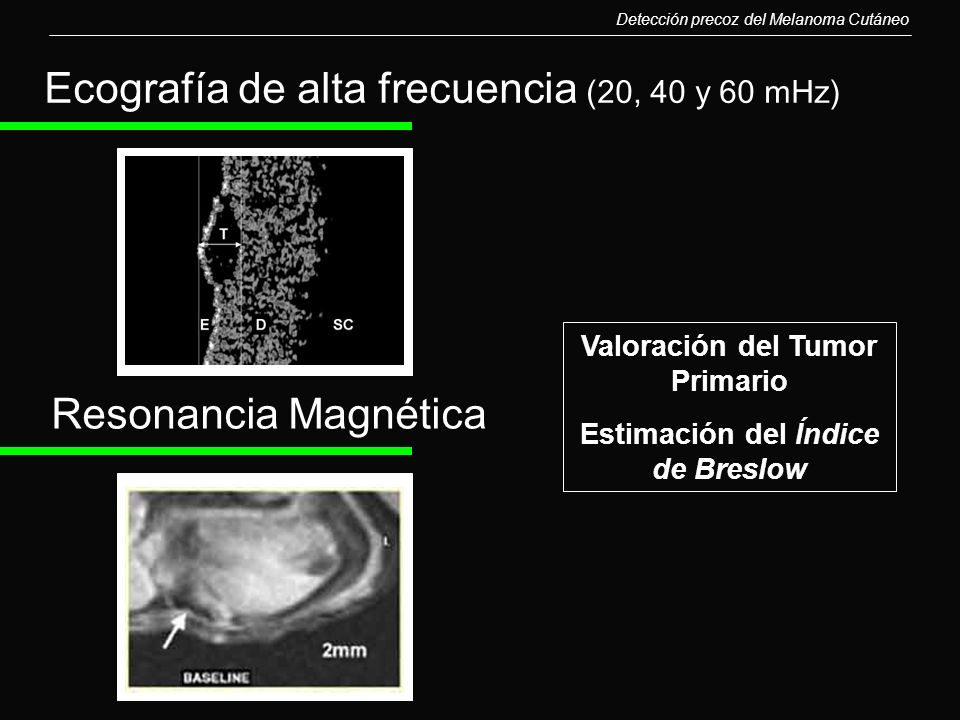 Valoración del Tumor Primario Estimación del Índice de Breslow