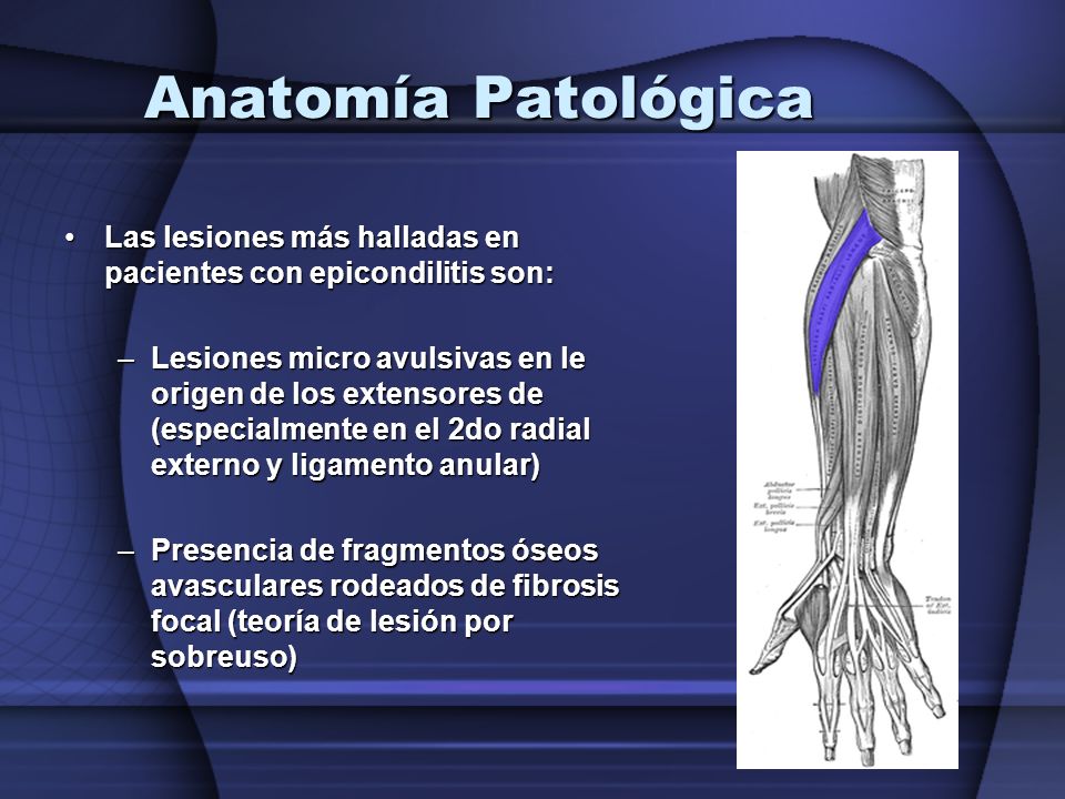 Anatomía Patológica Las lesiones más halladas en pacientes con epicondilitis son: