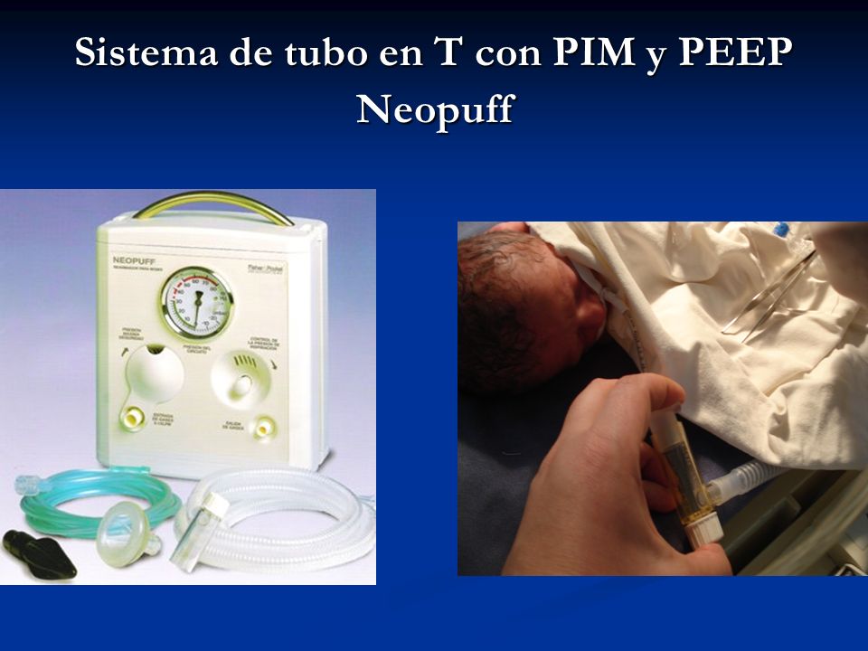 Sistema de tubo en T con PIM y PEEP Neopuff