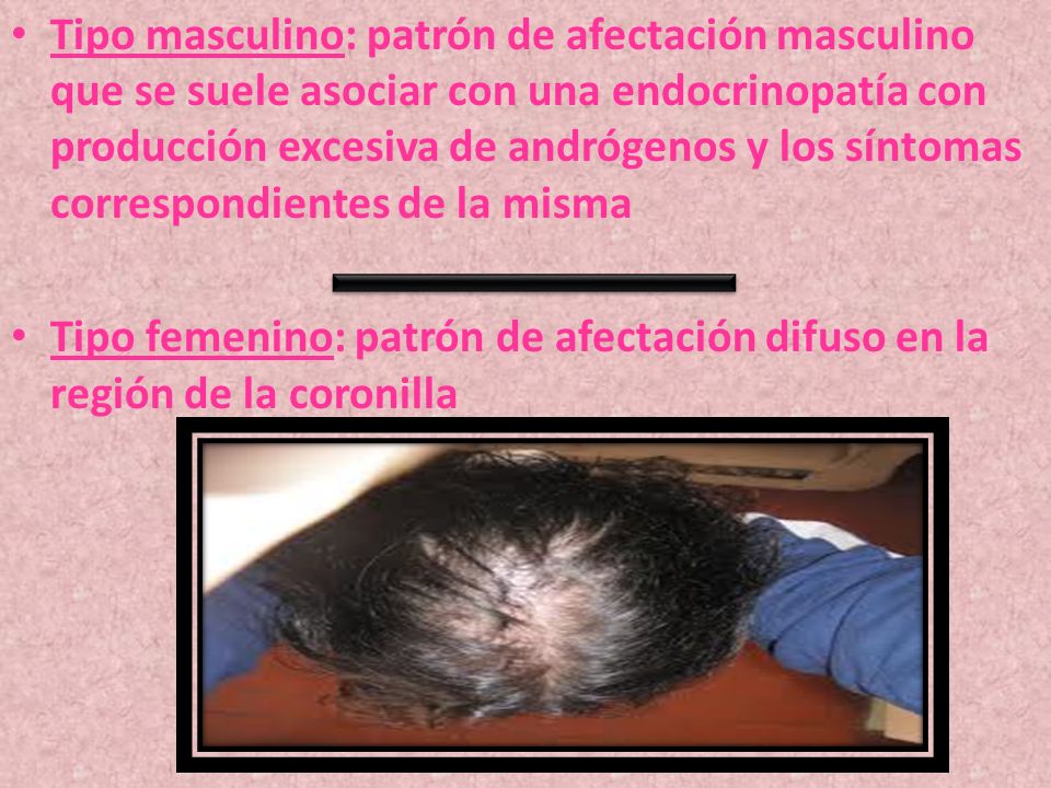 Tipo masculino: patrón de afectación masculino que se suele asociar con una endocrinopatía con producción excesiva de andrógenos y los síntomas correspondientes de la misma