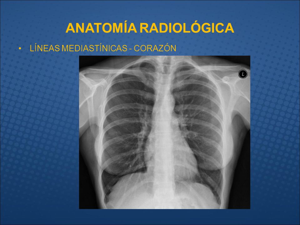 ANATOMÍA RADIOLÓGICA LÍNEAS MEDIASTÍNICAS - CORAZÓN