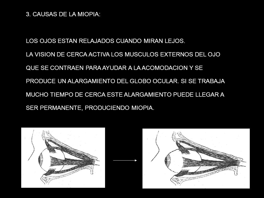 3. CAUSAS DE LA MIOPIA: LOS OJOS ESTAN RELAJADOS CUANDO MIRAN LEJOS. LA VISION DE CERCA ACTIVA LOS MUSCULOS EXTERNOS DEL OJO.