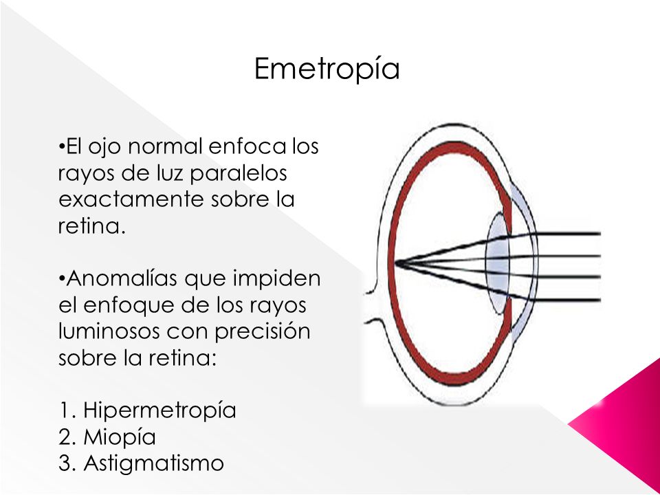 Emetropía El ojo normal enfoca los rayos de luz paralelos exactamente sobre la retina.