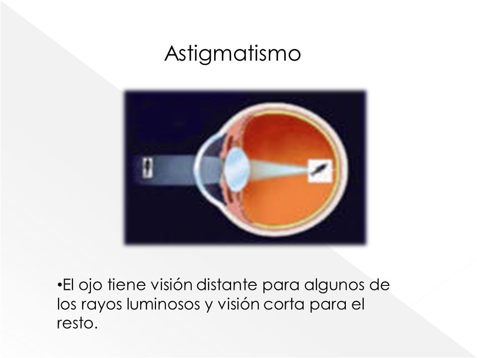Astigmatismo El ojo tiene visión distante para algunos de los rayos luminosos y visión corta para el resto.