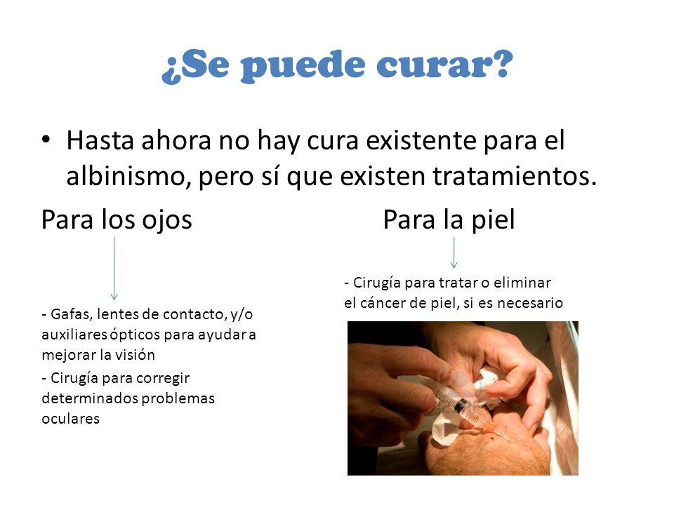 ¿Se puede curar Hasta ahora no hay cura existente para el albinismo, pero sí que existen tratamientos.