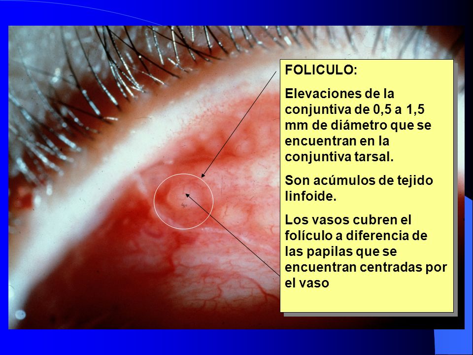 Folículos FOLICULO: Elevaciones de la conjuntiva de 0,5 a 1,5 mm de diámetro que se encuentran en la conjuntiva tarsal.