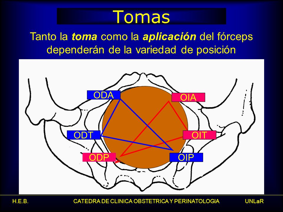 Tomas Tanto la toma como la aplicación del fórceps dependerán de la variedad de posición. ODA. ODT.