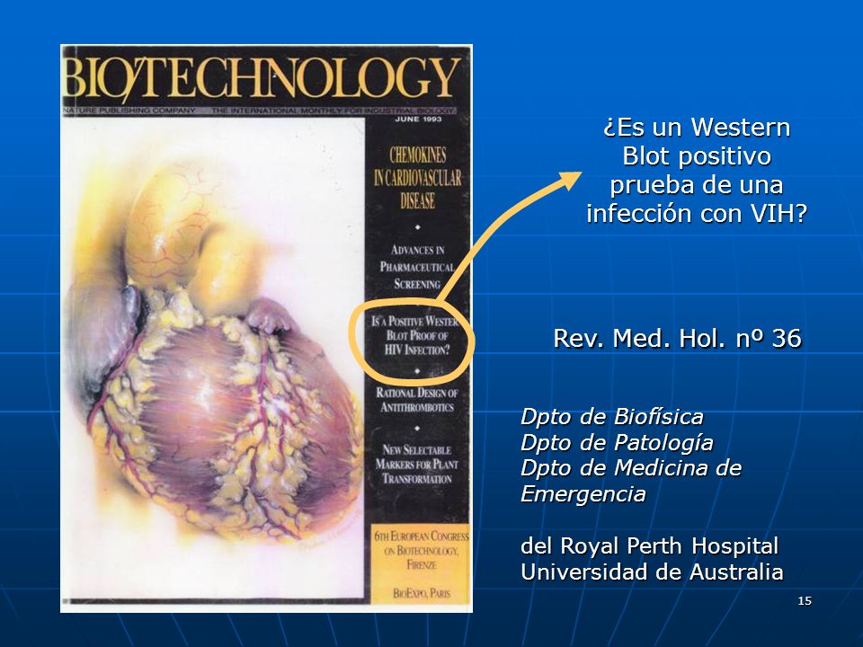 ¿Es un Western Blot positivo prueba de una infección con VIH