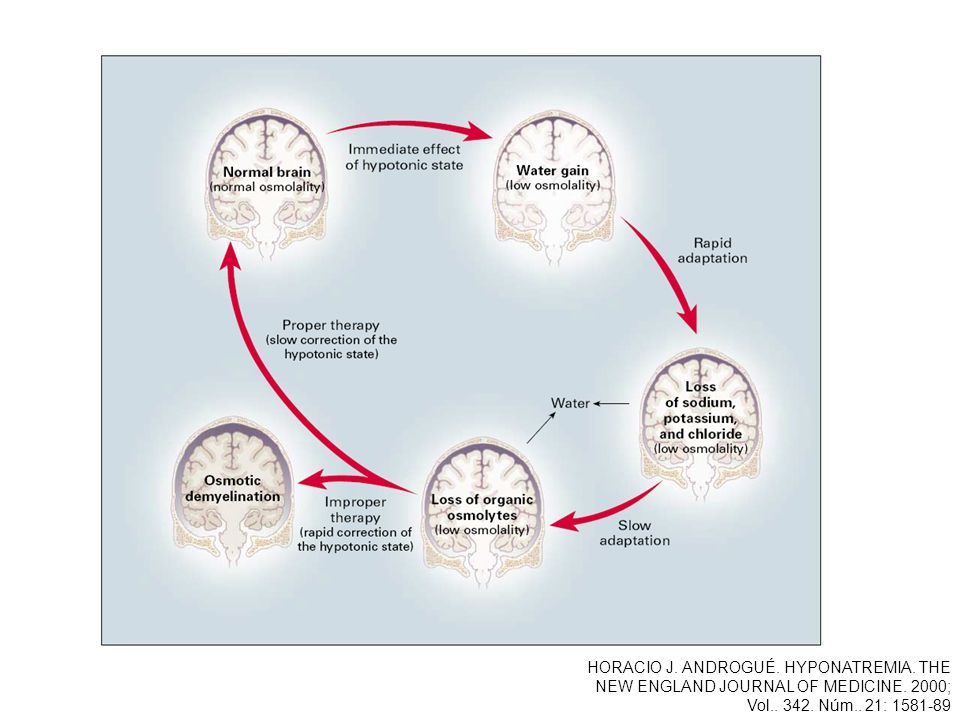HORACIO J. ANDROGUÉ. HYPONATREMIA. THE NEW ENGLAND JOURNAL OF MEDICINE