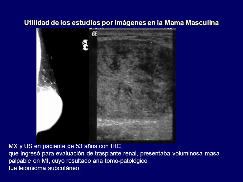 Utilidad de los estudios por Imágenes en la Mama Masculina